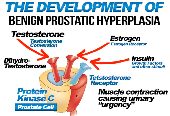 the development of benign prostatic hyperplasia