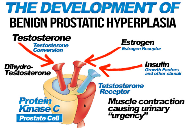 the development of benign prostatic hyperplasia